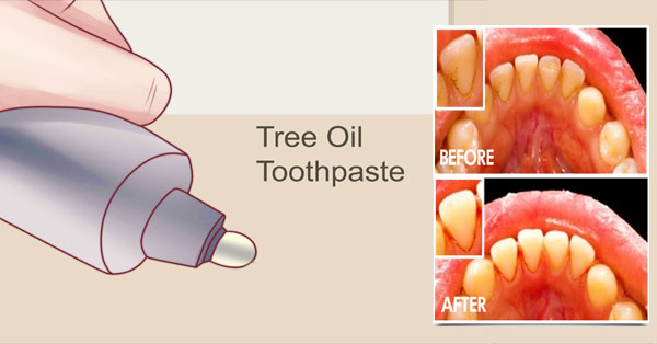 10 Natural Home Remedies to Treat Gum Disease